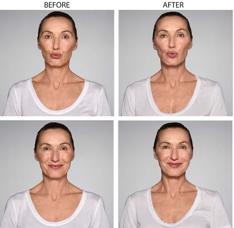 restylane refyne before and after