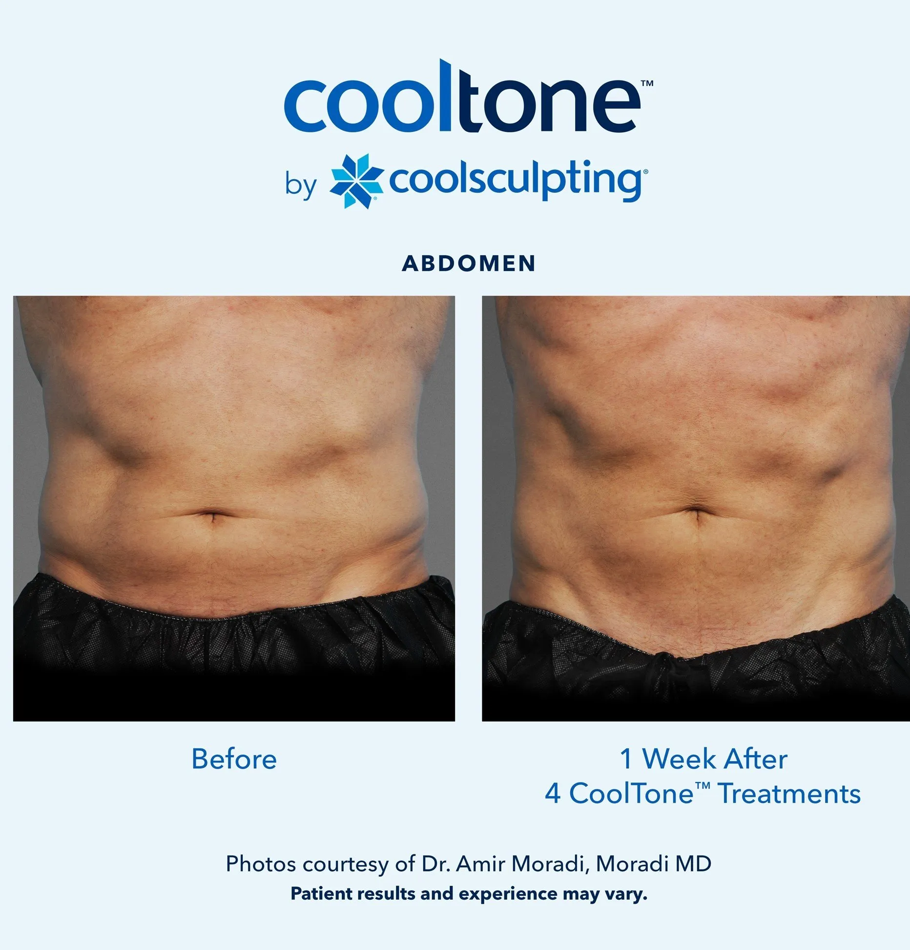 Cooltone before and after by coolsculpting