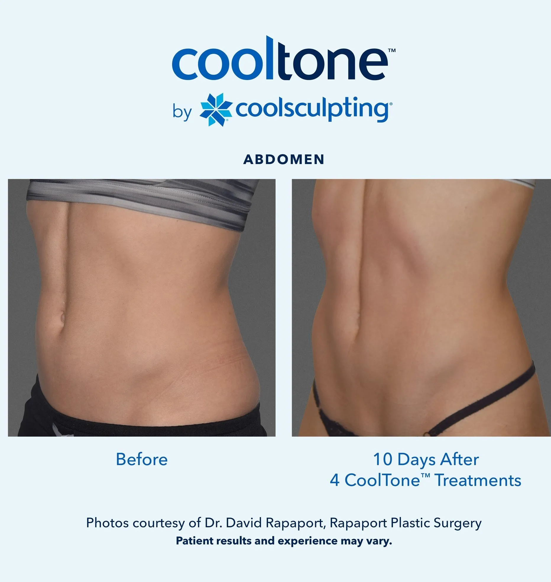 Cooltone before and after by coolsculpting
