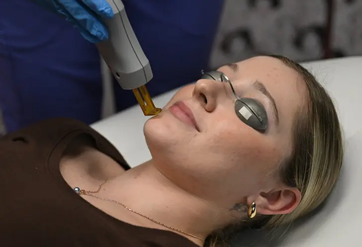 Smoothbeam laser treatment at DermFX
