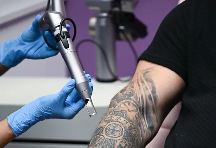 tattoo removal with Picore laser at DermFX