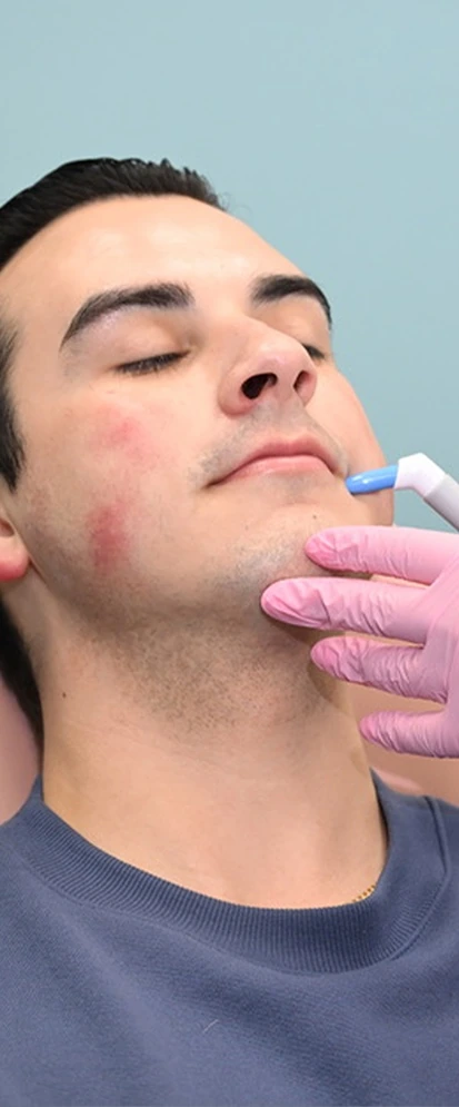 male client getting Agnes RF treatment