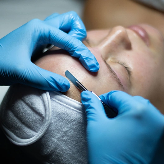 dermaplaning facial