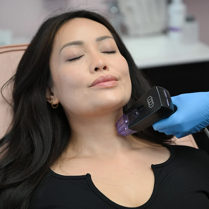 morpheus8 treatment on neck