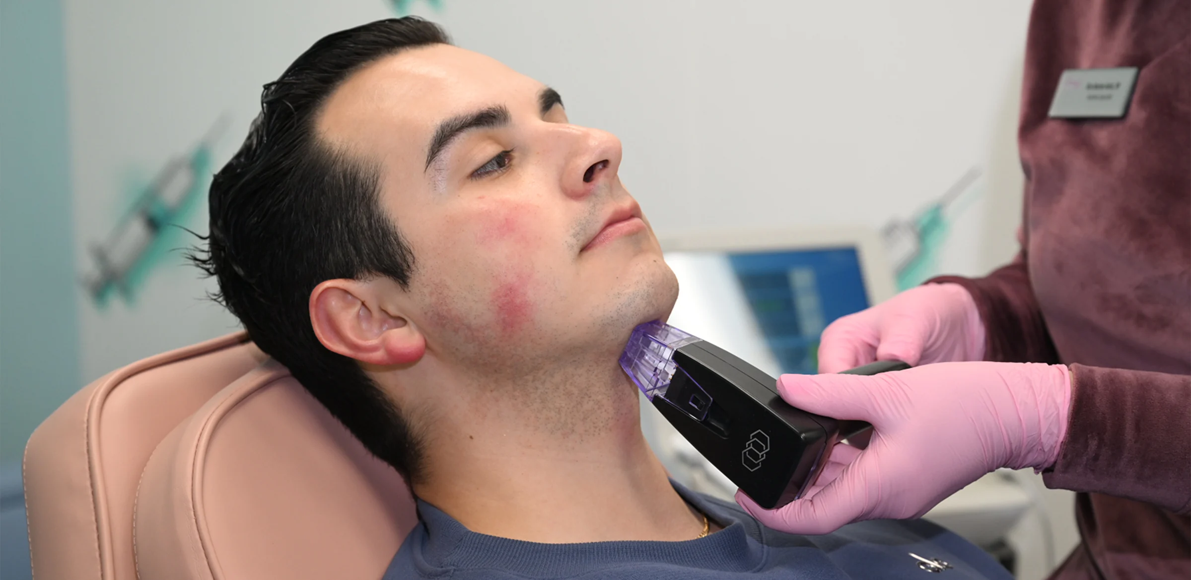 morpheus8 treatment DermFX
