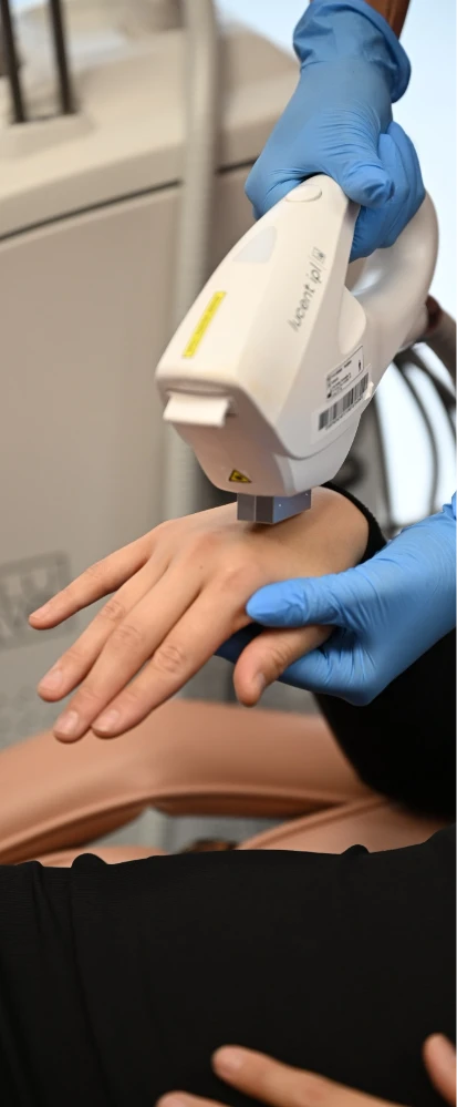 IPL treatment on hand