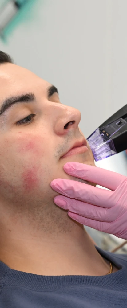 morpheus8 treatment on face