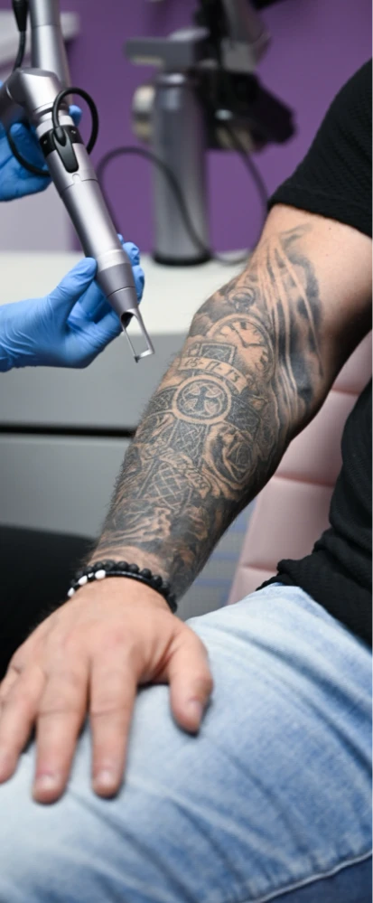 tattoo removal with picore laser