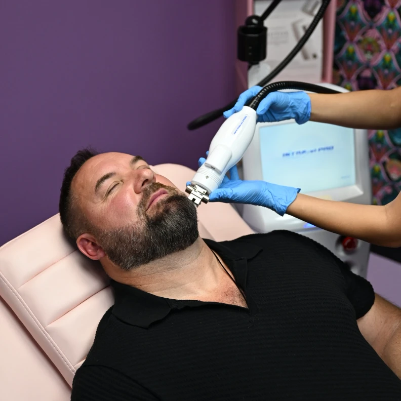 intracel RF microneedling