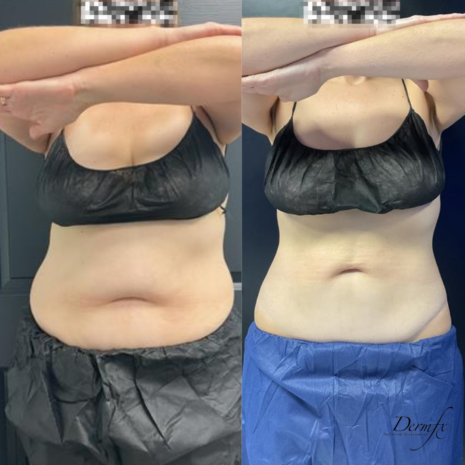 Case 14 after photo