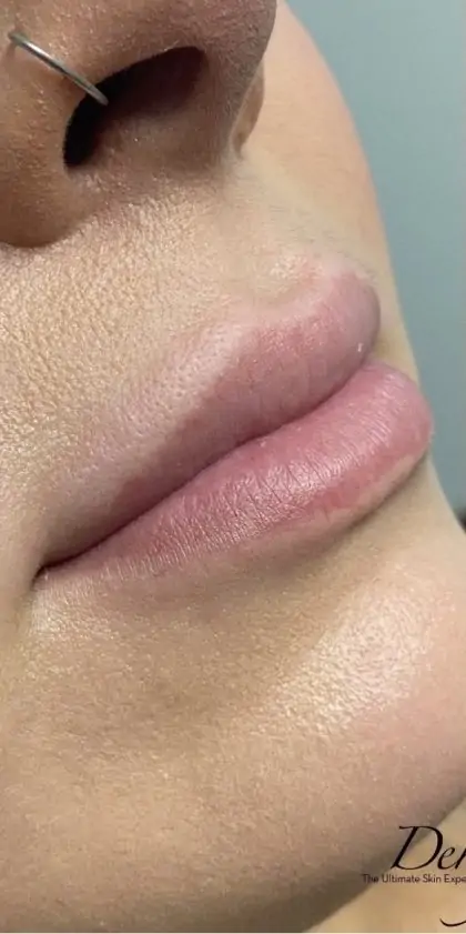 bna case