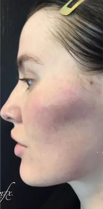 Case 1 after photo