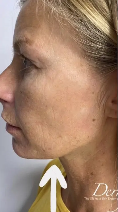 bna case