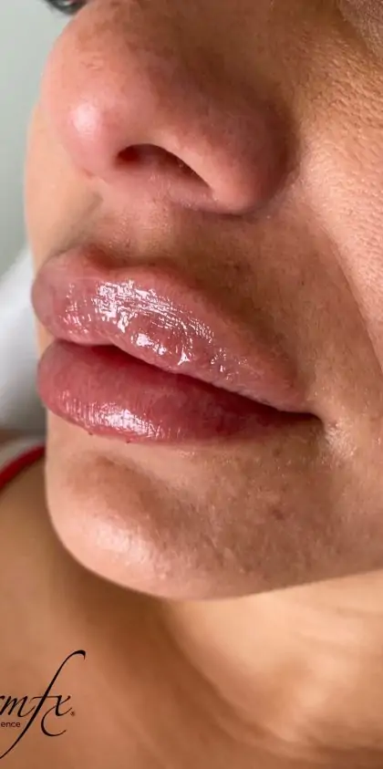 bna case