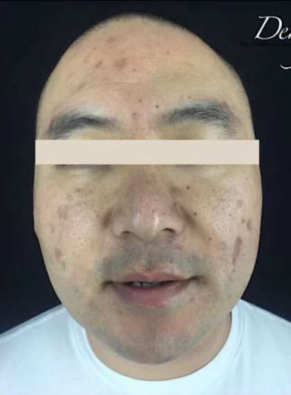 bna case