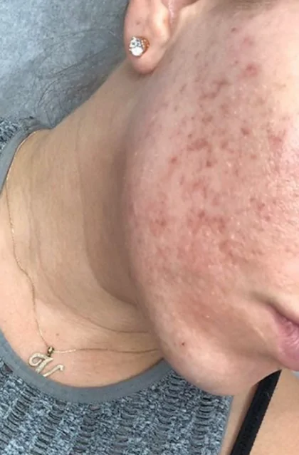 bna case