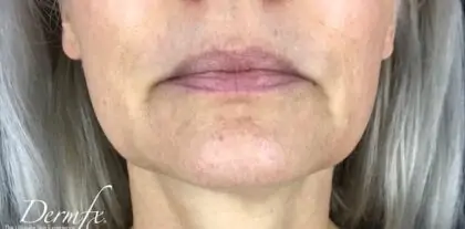 bna case