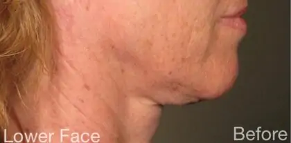 bna case