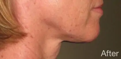 bna case