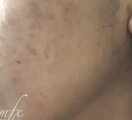 Case 1 after photo