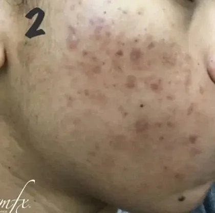 Case 3 after photo