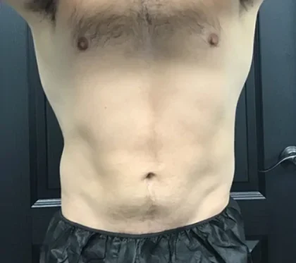 Case 12 after photo