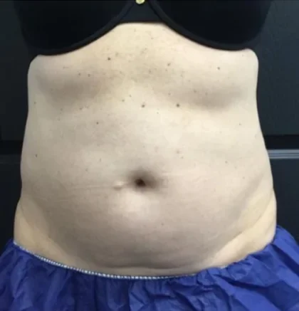 Case 4 before photo