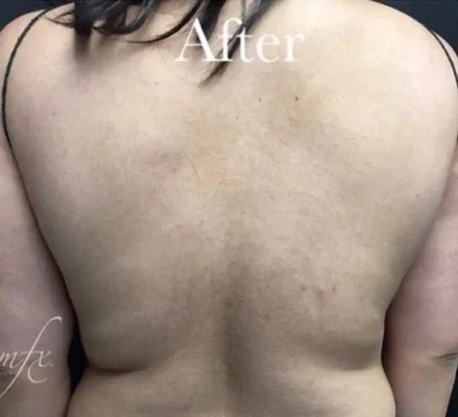 Case 5 after photo
