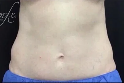 Case 6 after photo