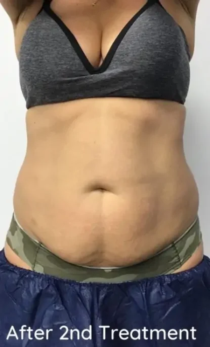 Case 8 after photo