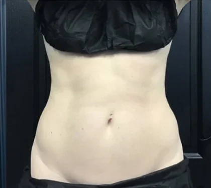Case 11 after photo