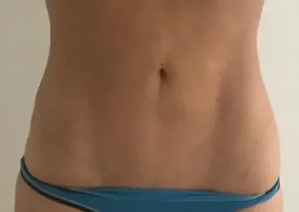 Case 1 after photo