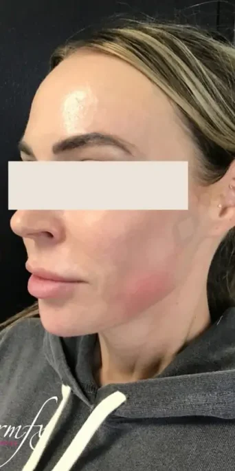 Case 4 after photo