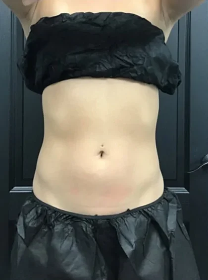 Case 2 after photo