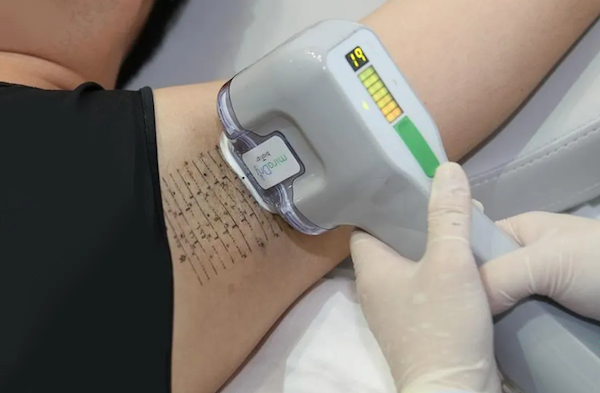 Best miraDry | DermFx