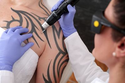 Laser Tattoo Removal At Laser Skin Care Clinic Dubai - LaserSkinCare.ae