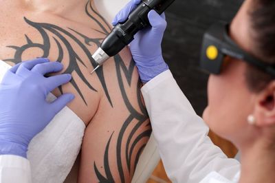 How Does Laser Tattoo Removal Work Pain Effectiveness Safety