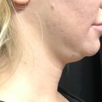 CoolSculpting Before & After Patient #657