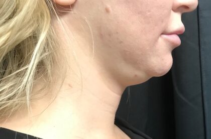 CoolSculpting Before & After Patient #657