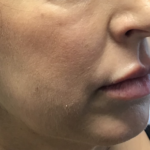 Cheek Fillers Before & After Patient #713