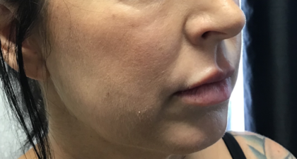 Cheek Fillers Before & After Patient #713