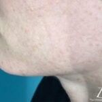 Chin Fillers Before & After Patient #716