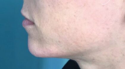 Chin Fillers Before & After Patient #716