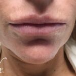 Chin Fillers Before & After Patient #719