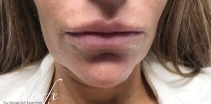 Chin Fillers Before & After Patient #719