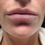 Chin Fillers Before & After Patient #719