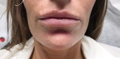 Chin Fillers Before & After Patient #719