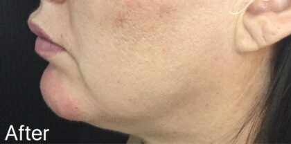 Chin Fillers Before & After Patient #722