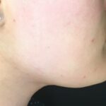 Chin Fillers Before & After Patient #725