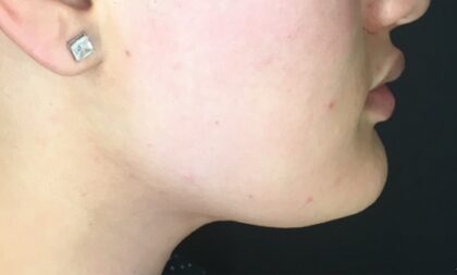 Chin Fillers Before & After Patient #725